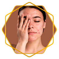 Remove a acne